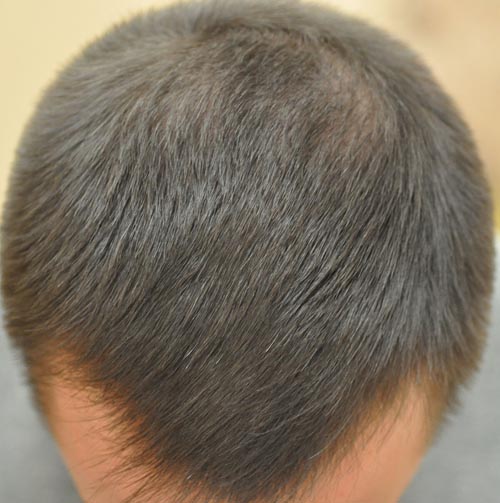 Результат лечения волос в Центре здоровья волос