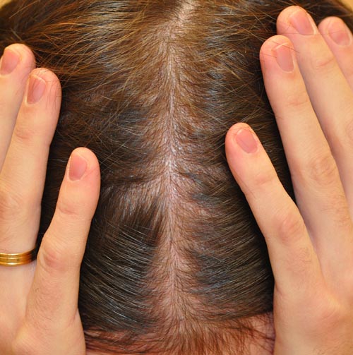 Принципы лечения потери объема волос