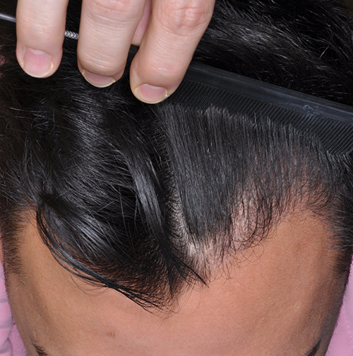Результат пересадки волос в Центре здоровья волос